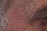 brown spot removal - after treatment