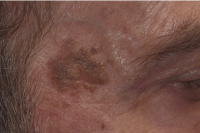 brown spot removal - before treatment