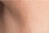 skin tag removal - after treatment