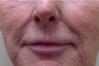 deep laser skin resurfacing - before