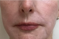 deep laser skin resurfacing - after