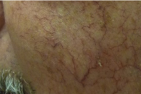 blood vessels treatment - before