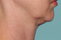 kybella - before