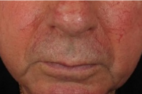 rosacea treatment - before