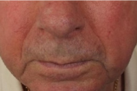 rosacea treatment - after