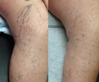 photos of Asclera spider vein before and after