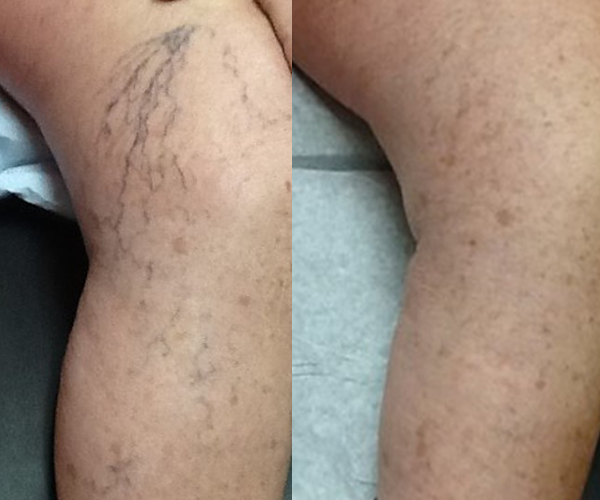 photos of Asclera spider vein before and after