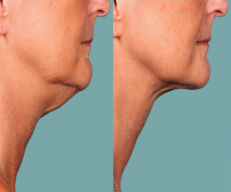 photos of Kybella before and after