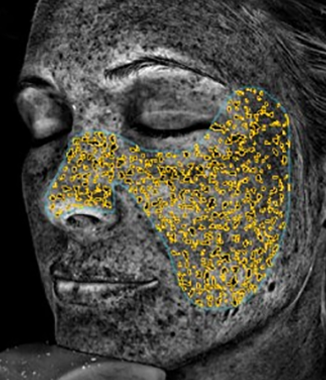 visia skin analysis