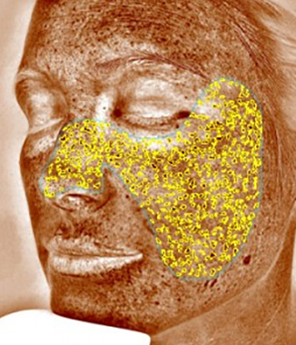 visia skin analysis