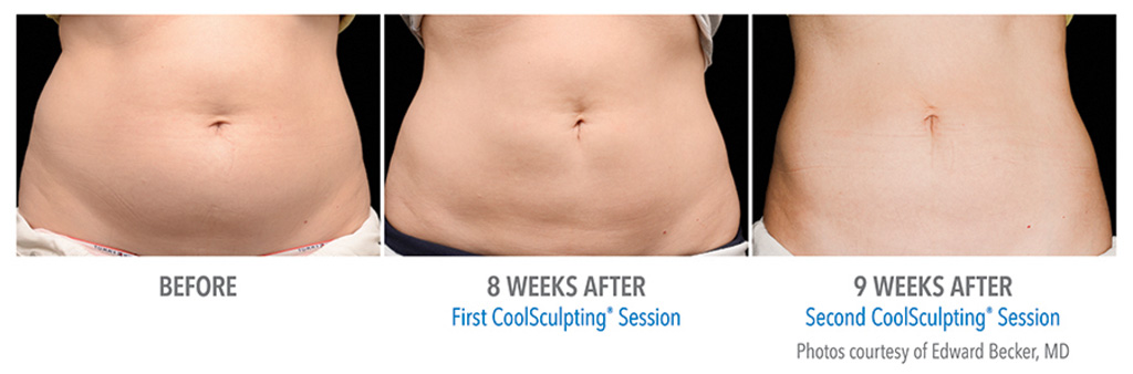 CoolSculpting® Flanks – Love Handles Photo Gallery