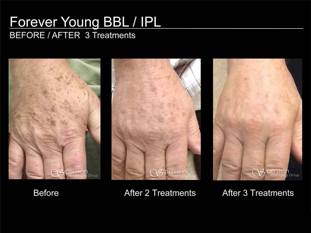 Forever Young BBL / IPL / Photofacial