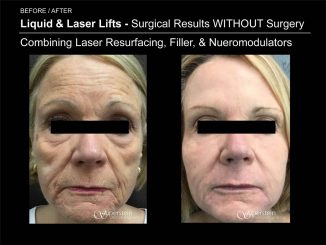 Liquid & Laser Lifts