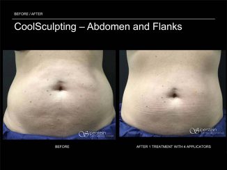 CoolSculpting