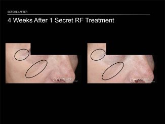 Cutera Secret Microneedling