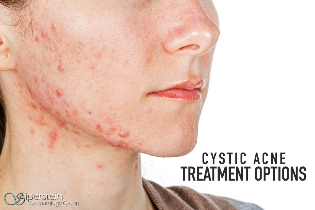 Everything You Need To Know About Cystic Acne Treatment