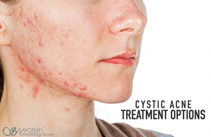 Cystic Acne Treatment