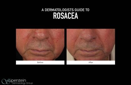 Dermatologists-Guide-To-Rosacea