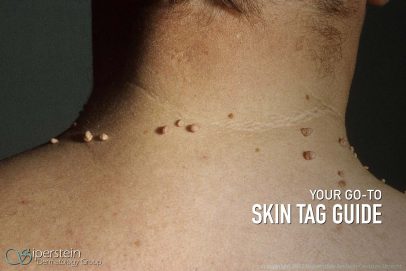 All Your Skin Tag Questions Answered By Professional Dermatologists