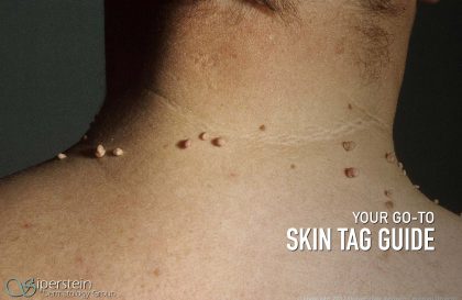 Skin Tag Guide