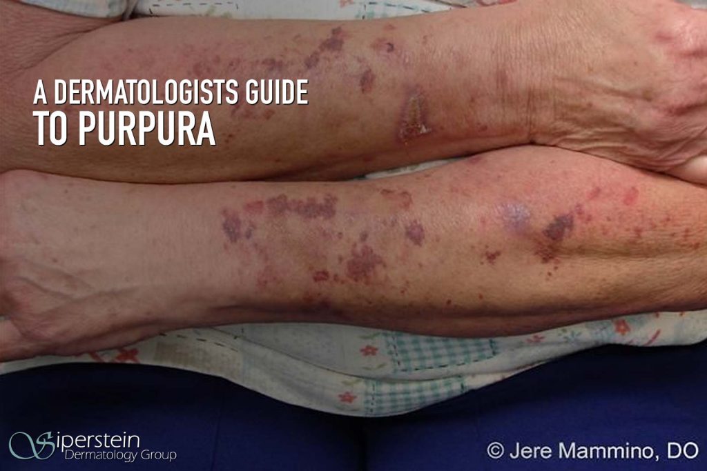 What Causes Purpura In The Elderly