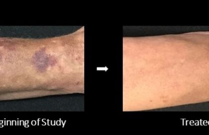 Senile Purpura Treatment - Before and After Images