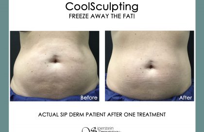 Coolsculpting Before and After Images - stomach fat