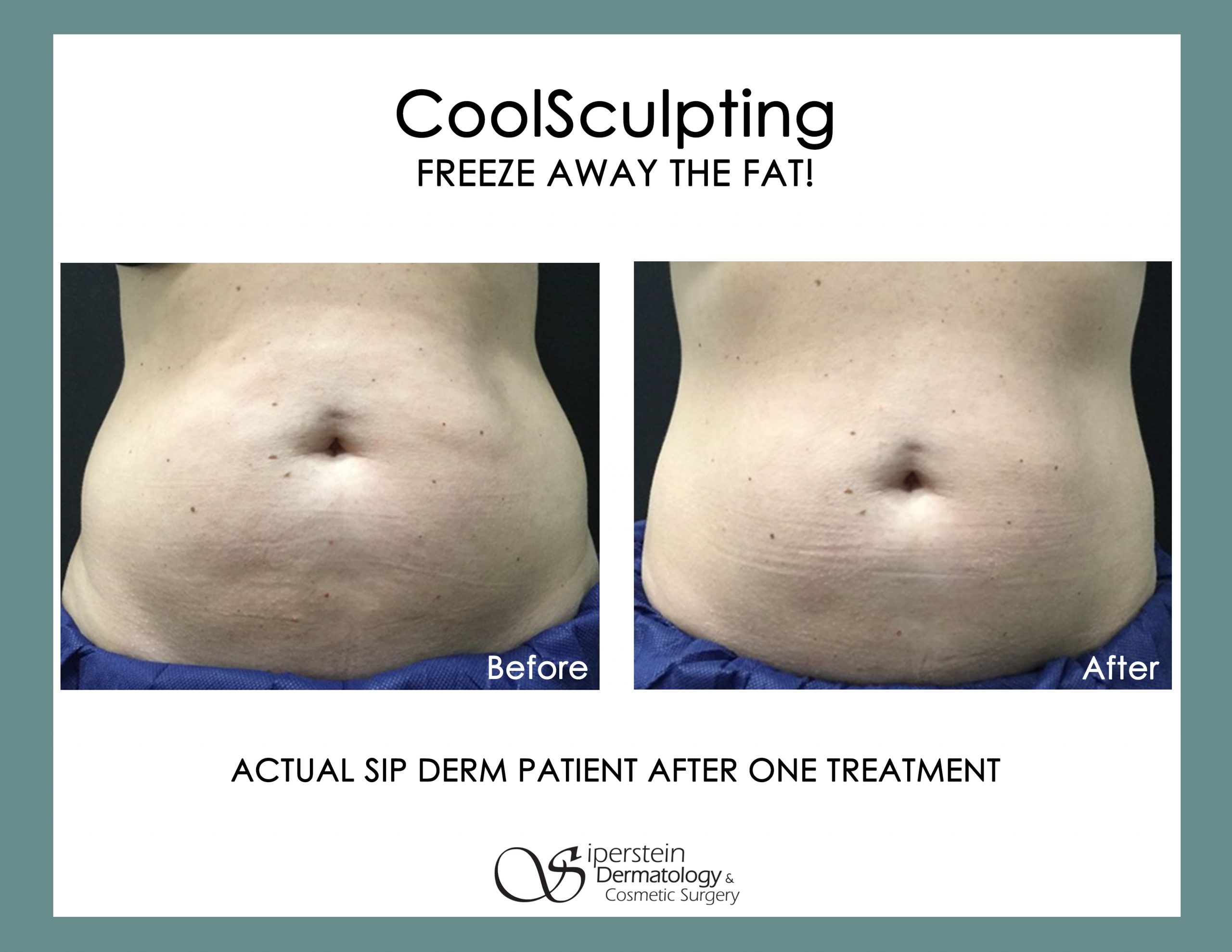 https://www.sipderm.com/wp-content/uploads/2021/04/coolsculpting24rev-1-scaled.jpg