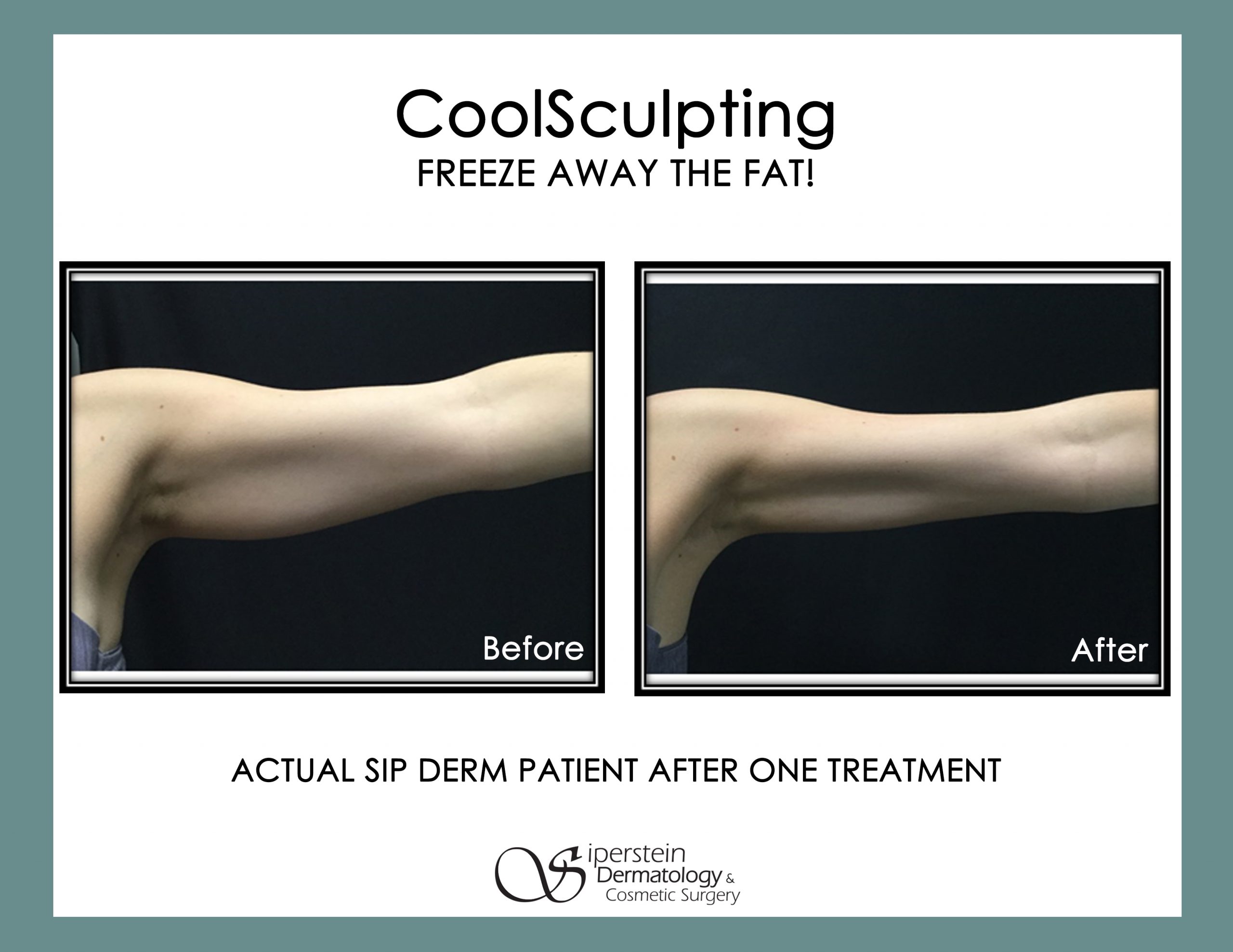 Coolshaping Fat Freezing Treatment
