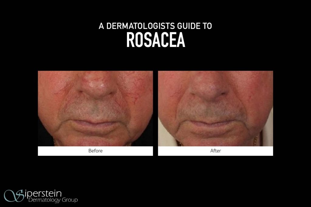 A Dermatologists Guide To Rosacea Siperstein Dermatology Group 8271