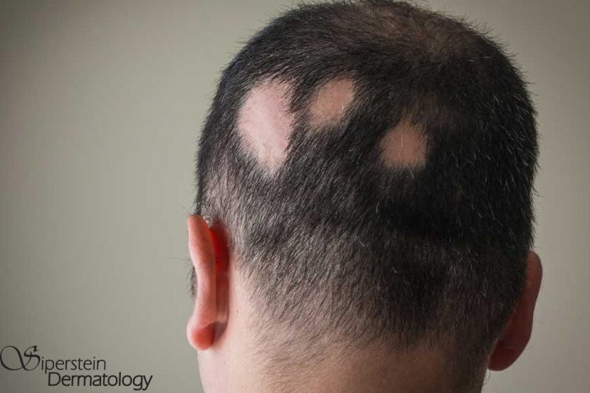 Alopecia Areata