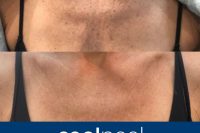 CoolPeel before and after