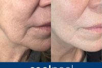 CoolPeel before and after