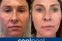 CoolPeel before and after