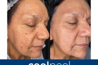 CoolPeel before and after