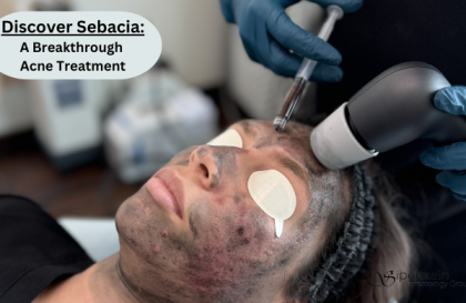 Sebacia Acne Treatment